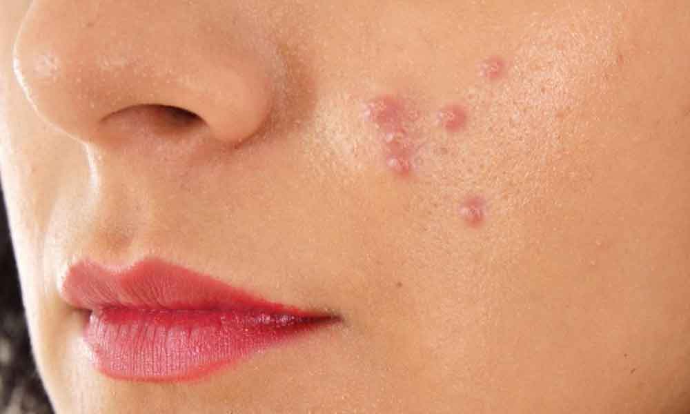 Home remedies to remove pimples