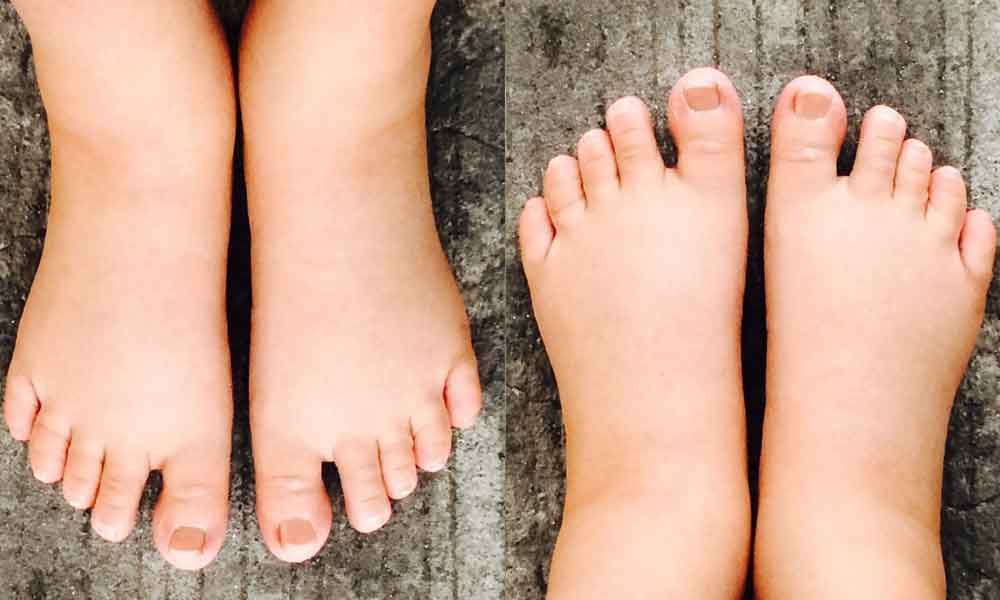 Swollen feet hand and mouth problem during pregnancy