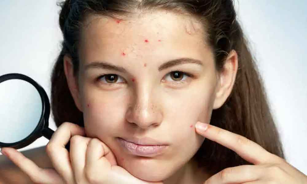 Home remedies for pimples during pregnancy